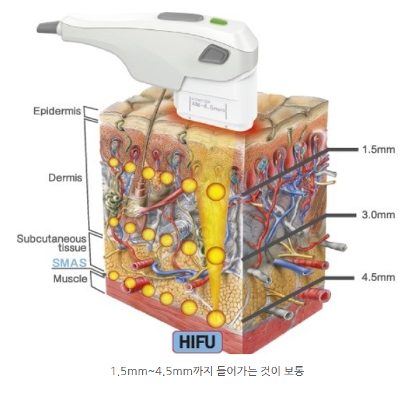 HIFU 작동 원리