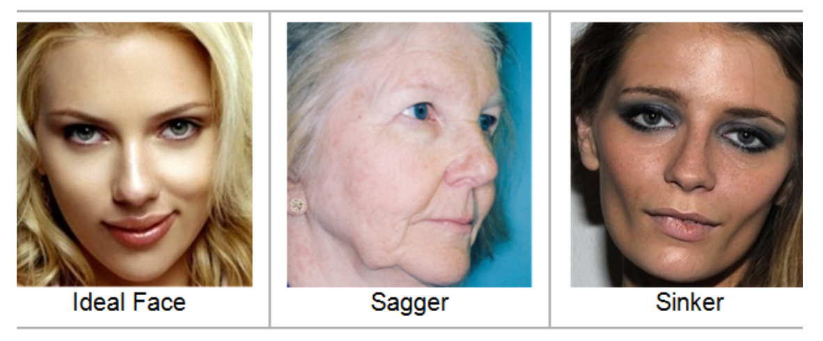 피부 노화 유형